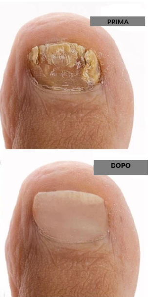 Achiche 7 giorni -  X1 Trattamento dei funghi delle unghie 30ML